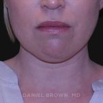 Neck Restoration Before & After Patient #10562