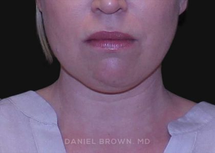 Neck Restoration Before & After Patient #10562