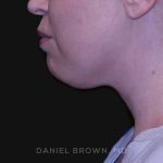 Neck Restoration Before & After Patient #10562