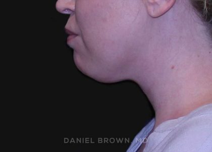 Neck Restoration Before & After Patient #10562