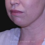Neck Restoration Before & After Patient #10562