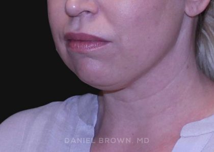 Neck Restoration Before & After Patient #10562