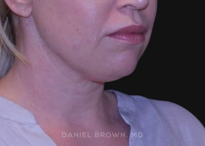 Neck Restoration Before & After Patient #10562