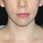 Neck Restoration Before & After Patient #10573