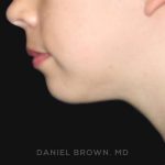 Neck Restoration Before & After Patient #10573