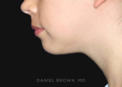 Neck Restoration Before & After Patient #10573