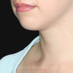 Neck Restoration Before & After Patient #10573