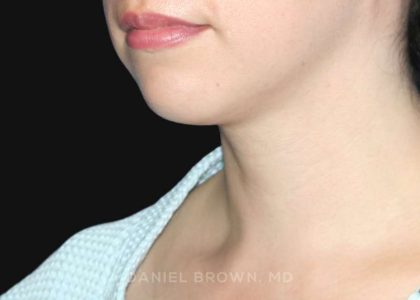Neck Restoration Before & After Patient #10573