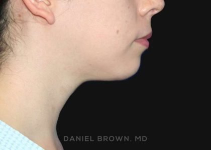 Neck Restoration Before & After Patient #10573