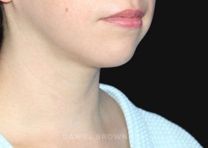 Neck Restoration Before & After Patient #10573