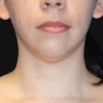 Neck Restoration Before & After Patient #10573