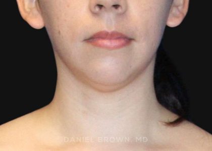 Neck Restoration Before & After Patient #10573