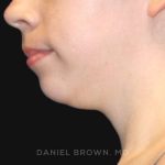 Neck Restoration Before & After Patient #10573