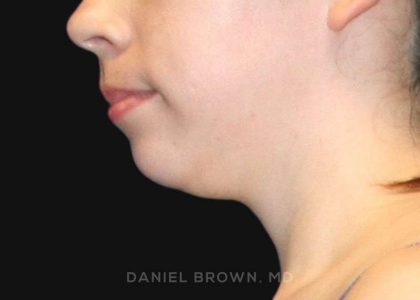Neck Restoration Before & After Patient #10573