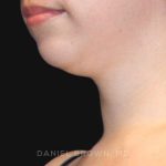 Neck Restoration Before & After Patient #10573