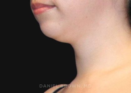 Neck Restoration Before & After Patient #10573