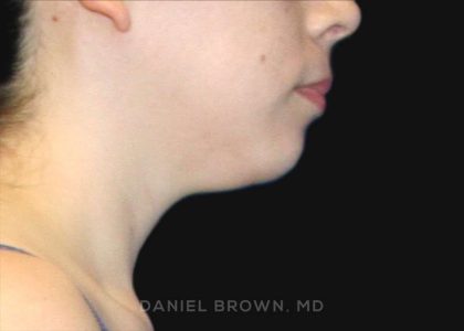 Neck Restoration Before & After Patient #10573