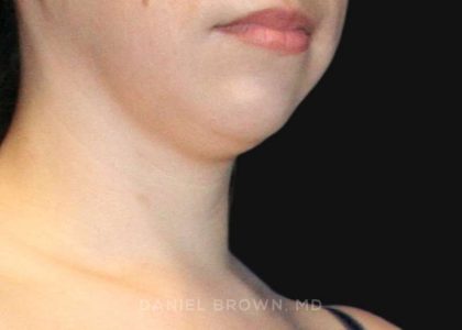 Neck Restoration Before & After Patient #10573