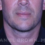 Neck Restoration Before & After Patient #10586