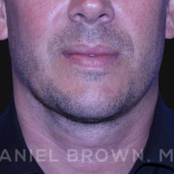 Neck Restoration Before & After Patient #10586