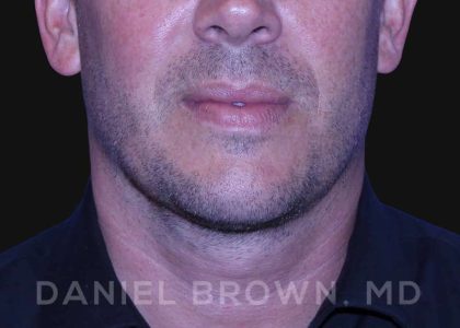 Neck Restoration Before & After Patient #10586