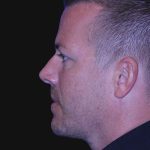 Neck Restoration Before & After Patient #10586
