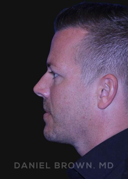 Neck Restoration Before & After Patient #10586