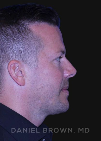 Neck Restoration Before & After Patient #10586