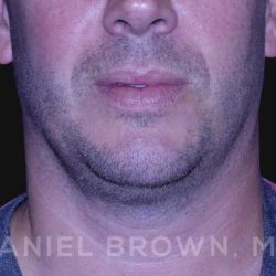 Neck Restoration Before & After Patient #10586