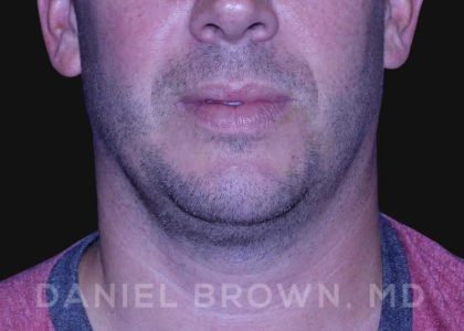 Neck Restoration Before & After Patient #10586