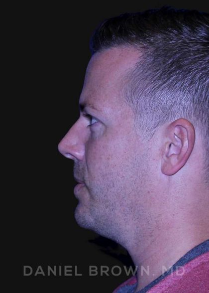 Neck Restoration Before & After Patient #10586