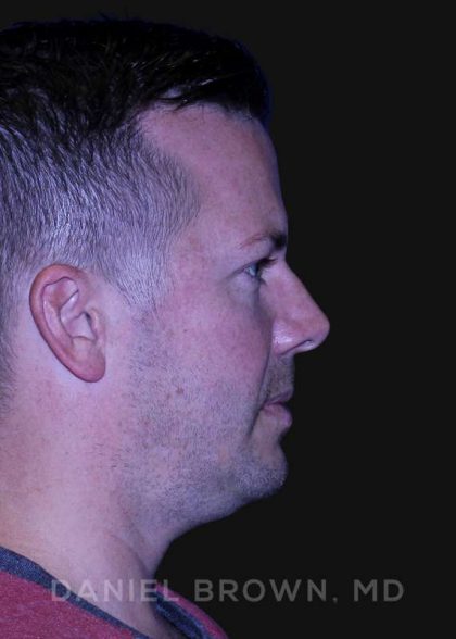 Neck Restoration Before & After Patient #10586
