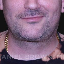 Neck Restoration Before & After Patient #10599