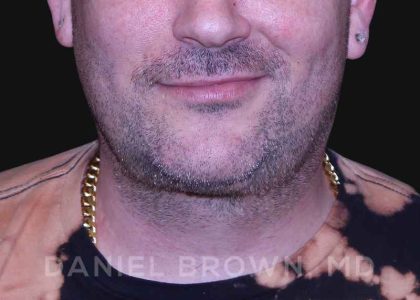 Neck Restoration Before & After Patient #10599