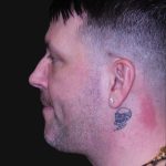 Neck Restoration Before & After Patient #10599