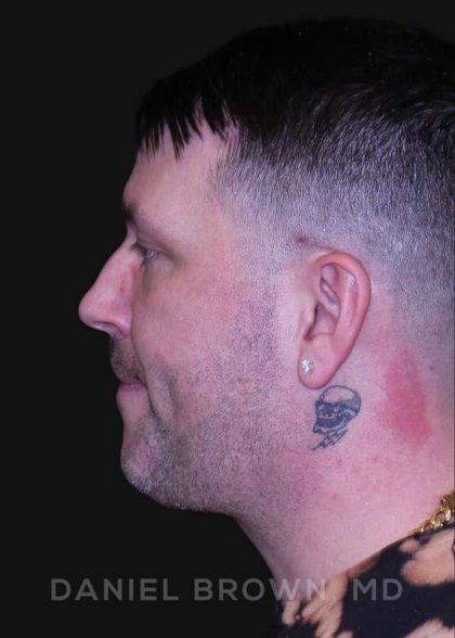 Neck Restoration Before & After Patient #10599