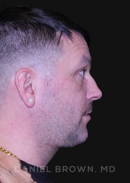 Neck Restoration Before & After Patient #10599
