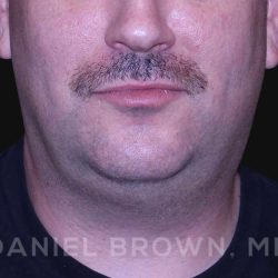 Neck Restoration Before & After Patient #10599