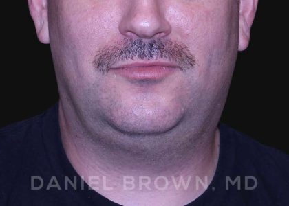 Neck Restoration Before & After Patient #10599
