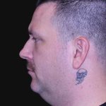 Neck Restoration Before & After Patient #10599