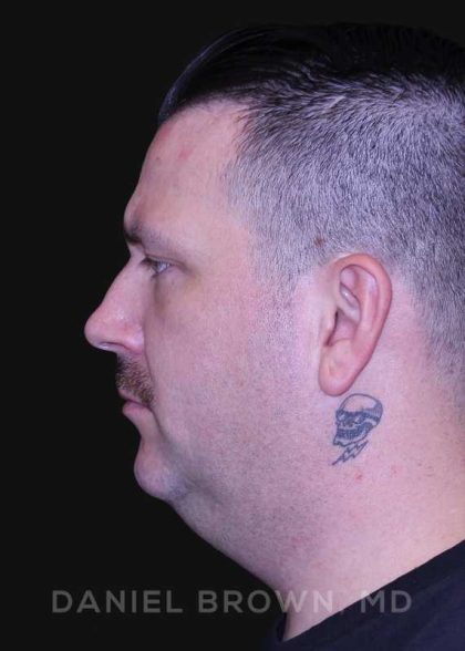 Neck Restoration Before & After Patient #10599
