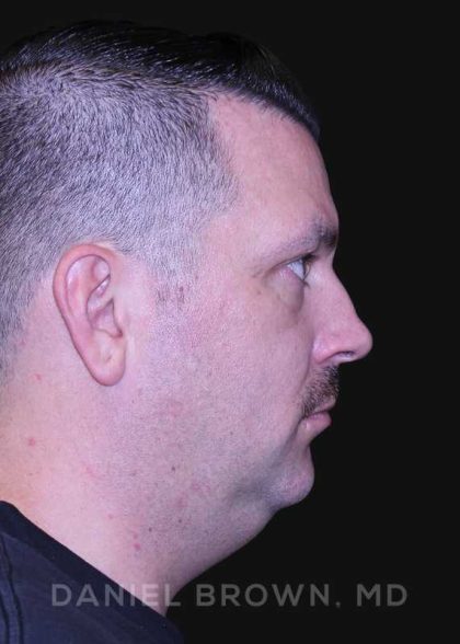 Neck Restoration Before & After Patient #10599