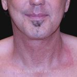 Neck Restoration Before & After Patient #10610