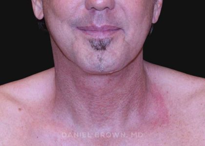 Neck Restoration Before & After Patient #10610