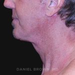 Neck Restoration Before & After Patient #10610