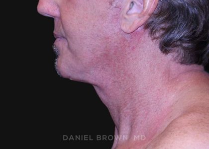 Neck Restoration Before & After Patient #10610