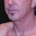 Neck Restoration Before & After Patient #10610