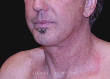 Neck Restoration Before & After Patient #10610