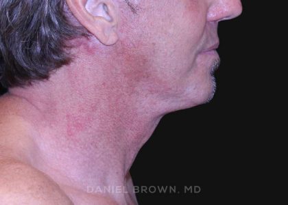 Neck Restoration Before & After Patient #10610