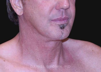 Neck Restoration Before & After Patient #10610